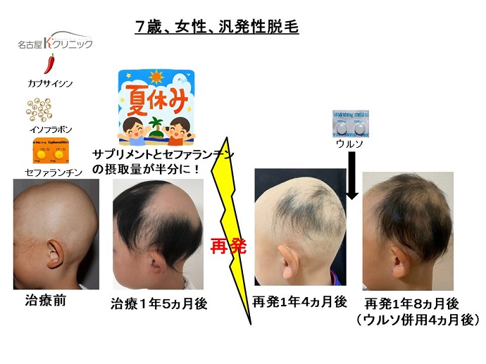 円形脱毛症　病院